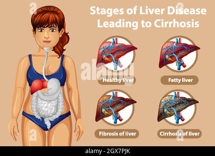 Stadien der Lebererkrankung, die zu einer Zirrhose führt Stock Vektor
