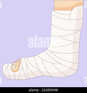 Gebrochenes Bein in einer Gussbandage, orthopädischer Gips, Verletzungsknochen, Vektorgrafik in einem flachen Stil gezeichnet. Stock Vektor