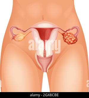 Diagramm des Eierstockkrebses im Detail Stock Vektor