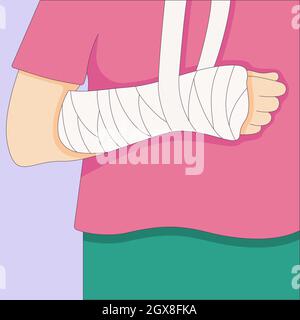 Gebrochener Arm in einem Guss-Verband, orthopädischer Gips, Verletzungsknochen, Vektorgrafik in einem flachen Stil gezeichnet. Stock Vektor