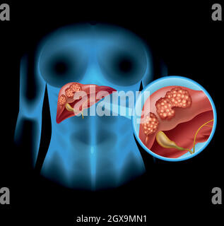 Leberkrebs Diagramm im Detail Stock Vektor