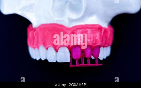 Zähne Implantat und Krone Installation auf einem blauen Hintergrund isoliert. Medizinisch genaue 3D-Darstellung Stockfoto