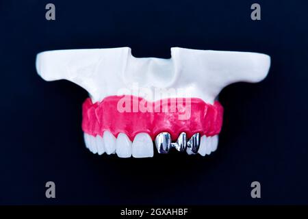 Zähne Implantat und Krone Installation auf einem blauen Hintergrund isoliert. Medizinisch genaue 3D-Darstellung Stockfoto