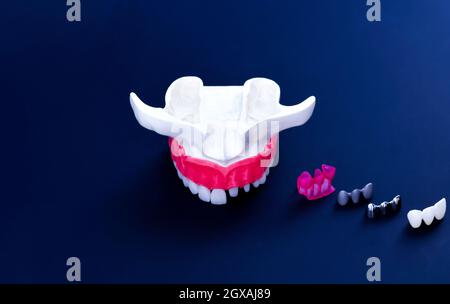 Zähne Implantat und Krone Installation auf einem blauen Hintergrund isoliert. Medizinisch genaue 3D-Darstellung Stockfoto