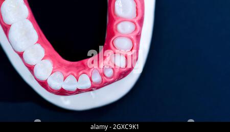 Zähne Implantat und Krone Installation auf einem blauen Hintergrund isoliert. Medizinisch genaue 3D-Darstellung Stockfoto