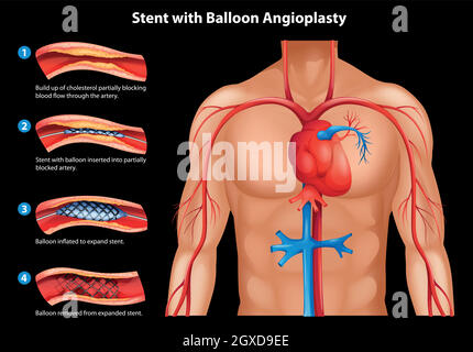 Angioplastie mit Ballon Stock Vektor