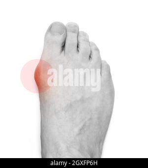 Varus valgus und Hallux valgus, Bunion auf weißem Hintergrund. Mit Beschneidungspfad Stockfoto