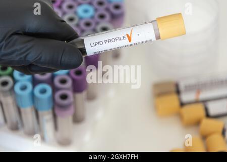 Nahaufnahme einer positiven Blutprobe aus dem Lipidprofil. Stockfoto