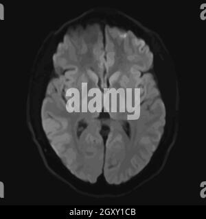 Realistisches axiales Bild des männlichen Großhirns mit CT-Scan, MRT-Magnetresonanztomographie-Schicht des Gehirns. Isoliert auf dunklem Hintergrund. Vektorgrafik. Stockfoto