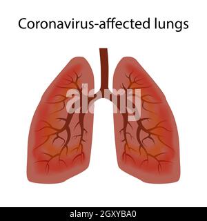 Menschliche Lunge durch Coronavirus Covid-19 beschädigt. Das Konzept des Stadiums der Schädigung des Atemwegsvirus. Isolierter Vektor EPS10. Stock Vektor