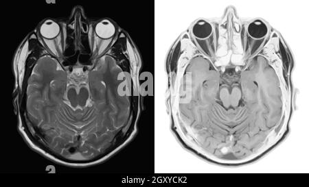 Realistischer Querschnitt des Gehirns mit CT-Scan, MRT Magnetresonanztomographie der Kopfschicht. Vektorgrafik. Stock Vektor