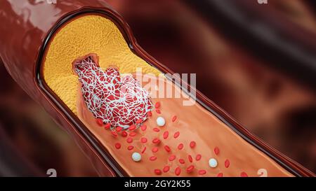 Krankhafte Arterie oder Blutgefäß, verstopft durch Cholesterin- oder Atheroma-Plaque und Blutgerinnsel, 3D-Darstellung. Chirurgie, Medizin, Kardiologie, hea Stockfoto