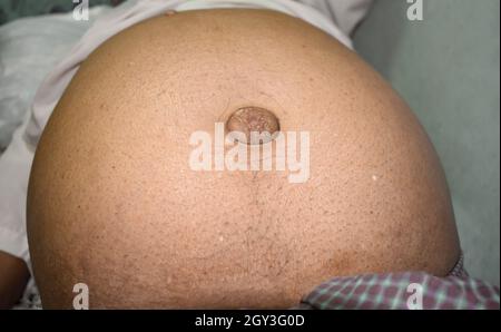 Bauchfett bei Patienten mit ascities und paraumbilikalen Hernien. Flanke ist voll. Stockfoto