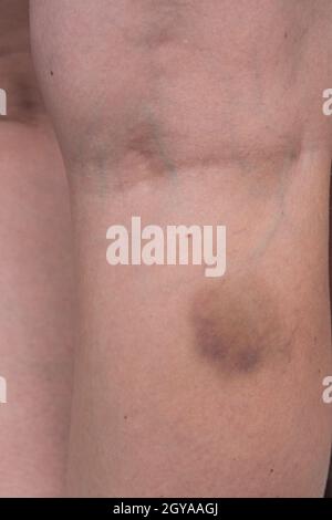 Großes Hämatom, Bluterguss am Bein der Frau, Schmerzkonzept aus der Nähe. Stockfoto