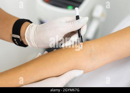 Der Spezialist für die Laserhaarentfernung zieht mit einem Schutzstift Maulwürfe auf der Hand der Frau an Stockfoto