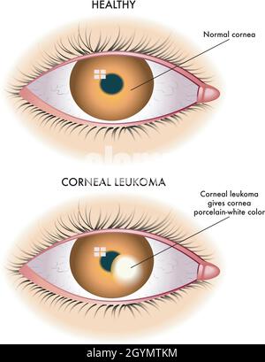 Die medizinische Illustration zeigt den Vergleich zwischen einem normalen Auge und einem von kornealem Leukoma betroffenen Auge. Stock Vektor