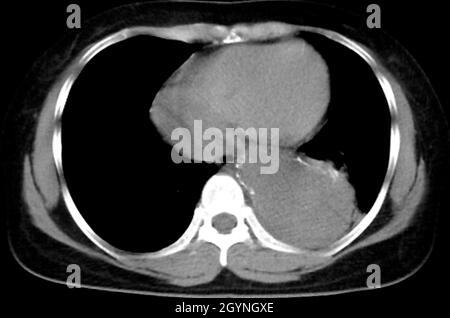 Aortenaneurysma, CT-Scan Stockfoto