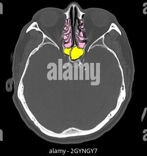 Anatomie des paranasalen Sinus, CT-Scan Stockfoto