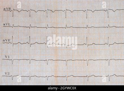 Nahaufnahme eines Elektrokardiogramms mit erhöhter Herzfrequenz und Herzrhythmusstörungen. Elektrokardiogramm als Diagnose Stockfoto