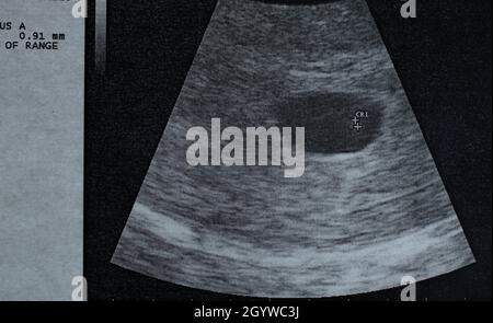 Ultraschallbild des Embryos ohne Herzschlag, entwickelt sich nach 6 Wochen nicht mehr Stockfoto