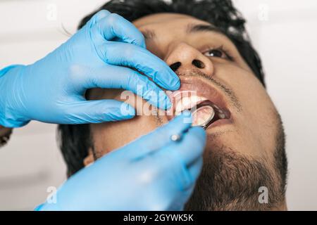 Nahaufnahme der Hände eines behandelten Zahnarztes, der einen männlichen Patienten mit einem kleinen Spiegel untersucht Stockfoto