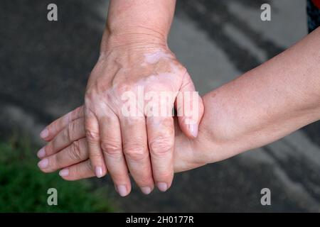 Weibliche Hände mit Vitiligo Nahaufnahme. Die Hände der Frau wurden übereinander gefaltet, die Nägel ohne Lack. Vitiligo auf der Haut einer Frau. Krankheiten der Stockfoto