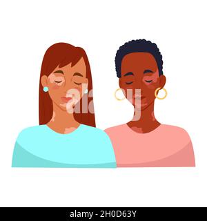 Zwei Frauen mit Vitiligo. Vitiligo Hautkrankheit. Vektorgrafik Stock Vektor