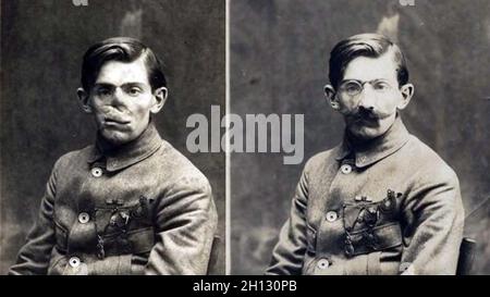 Ein vorher-Nachher-Foto mit einem französischen Soldaten, dessen Gesicht im Ersten Weltkrieg verstümmelt wurde, in einer Maske, die im Studio des amerikanischen Roten Kreuzes von Anna Coleman Ladd, 1918, angefertigt wurde. Stockfoto