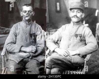 Ein vorher-Nachher-Foto mit einem französischen Soldaten, dessen Gesicht im Ersten Weltkrieg verstümmelt wurde, in einer Maske, die im Studio des amerikanischen Roten Kreuzes von Anna Coleman Ladd, 1918, angefertigt wurde. Stockfoto