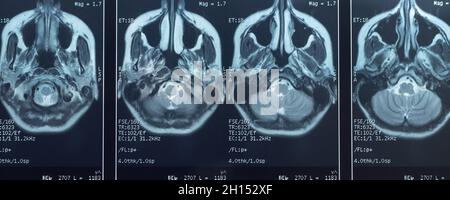 Nahaufnahme einer MRT des Schädels und des Gehirns einer Person mit schweren Kopfschmerzen; magnetische und nukleare Resonanz als diagnostische Methode in der Neurologie Stockfoto