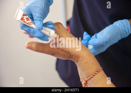 Kaukasische Frau mit gebrochenen Händen Afrikanische Krankenschwester, die Creme auf die Wunden setzt Stockfoto