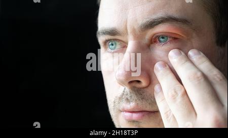 Trauriger Mann Berühren Sie sein schweres, von Konjunktivitis betroffenes Rotblutauge Stockfoto