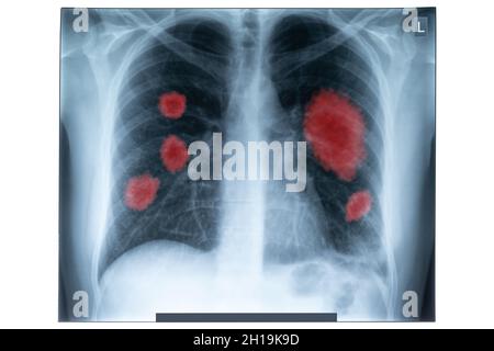 Röntgenbild des menschlichen Brustkorbs für eine medizinische Diagnostik. Coronavirus-COVID-19. Epidemien-Virus 2019-nCoV Respiratory Syndrome. Medizinkonzept. Stockfoto