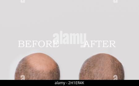 Menschliche Alopezie oder Haarausfall - Erwachsener Mann Hand hält Kamm auf Glatze Kopf. Vorher- und Nachher-Konzept Stockfoto