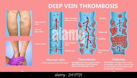 Tiefe Venenthrombose oder Blutgerinnsel. Embolus. Struktur der normalen weiblichen Venen und Krampfadern Stockfoto