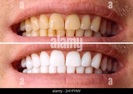 Zähne vor und nach dem Aufhellen. Auf weißem Hintergrund. Patient in der Zahnklinik. Bild symbolisiert Zahnheilkunde, Stomatologie Stockfoto