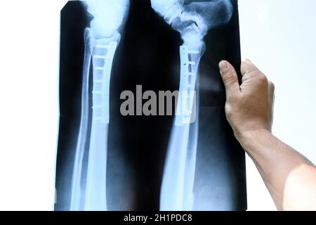 X-ray des Beines. Eine Stahlplatte zusammen halten, das Schienbein des Beines. Stockfoto