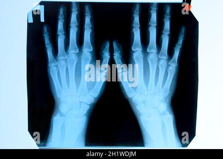 X-ray der Hände, ein Bild von den Knochen der Hände auf den x-ray. Stockfoto