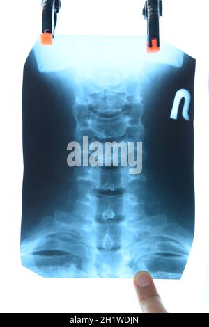 X-ray von der Halswirbelsäule. Röntgenbild der Halswirbelsäule. Stockfoto