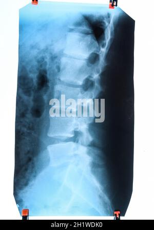 X-ray von der Lendenwirbelsäule Wirbelsäule auf x-ray Stockfoto