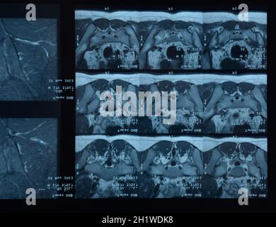 MRI sacroiliac Artikulation. Studie der ankylosierenden spondyloarthritis Patienten. Die Ergebnisse der Studie über die x-ray. Stockfoto