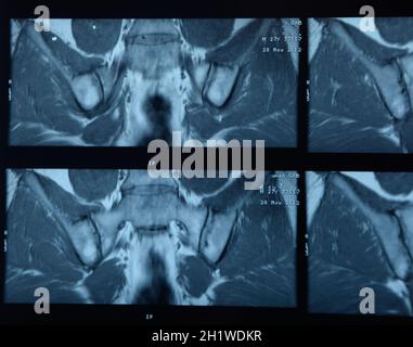 MRI sacroiliac Artikulation. Studie der ankylosierenden spondyloarthritis Patienten. Die Ergebnisse der Studie über die x-ray. Stockfoto