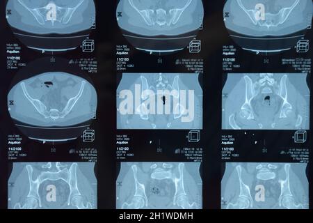 MRI sacroiliac Artikulation. Studie der ankylosierenden spondyloarthritis Patienten. Die Ergebnisse der Studie über die x-ray. Stockfoto