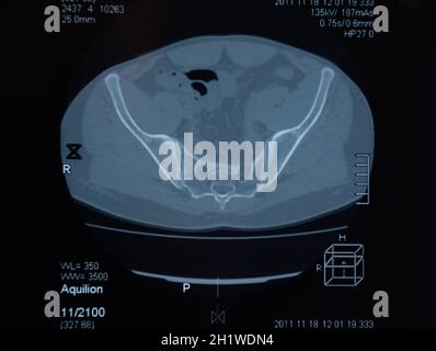 MRI sacroiliac Artikulation. Studie der ankylosierenden spondyloarthritis Patienten. Die Ergebnisse der Studie über die x-ray. Stockfoto