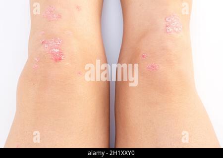 Kniegelenkerguss (Wasser auf dem Knie).Psoriatische Arthritis, Meniskusverletzung.überschüssige Synovialflüssigkeit im und um das linke Kniegelenk Stockfoto