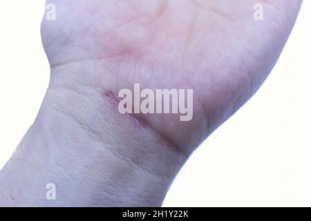 Gelenkerguss im Handgelenk aufgrund von Traumata durch die Ausübung von Sport Stockfoto