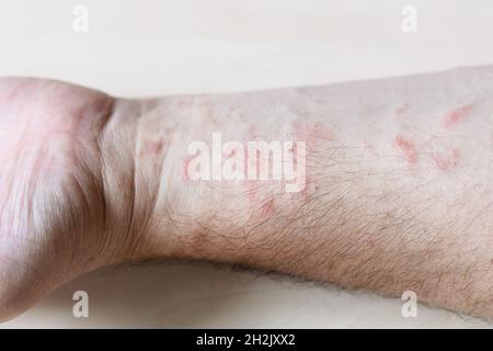 Probe der allergischen Kontaktdermatitis - Hautausschlag auf der Innenseite des Unterarms aus nächster Nähe Stockfoto