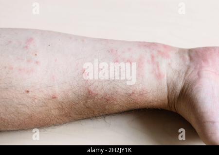 Probe der allergischen Kontaktdermatitis - Hautentzündung auf der Innenseite des Unterarms aus nächster Nähe Stockfoto