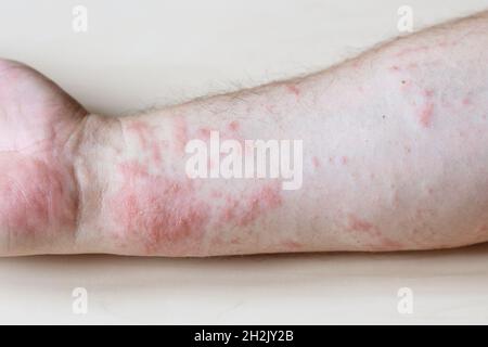 Probe der allergischen Kontaktdermatitis - juckender Ausschlag auf der Seite des Unterarms aus nächster Nähe Stockfoto