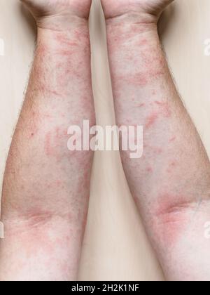 Probe der allergischen Kontaktdermatitis - männliche Arme mit juckenden roten Ausschlägen Stockfoto